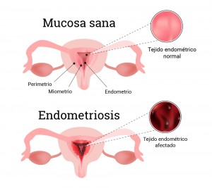 endometriosis-g